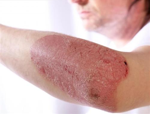 牛皮癣 牛皮癣